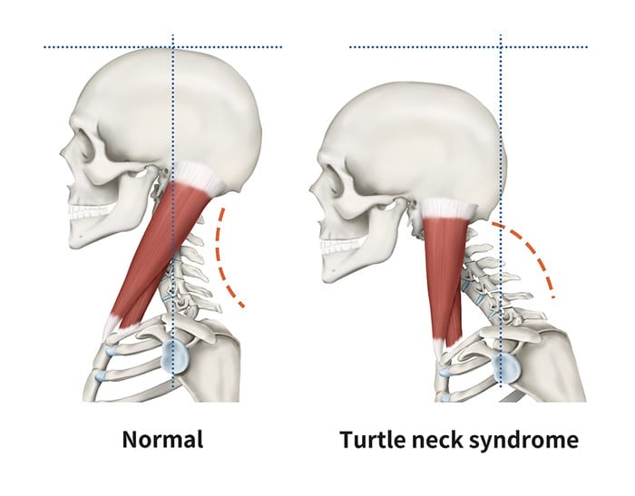 Turtle Neck Syndrome