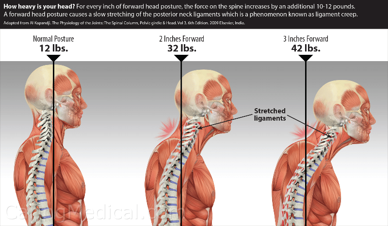 turtle neck syndrome physiotherapy