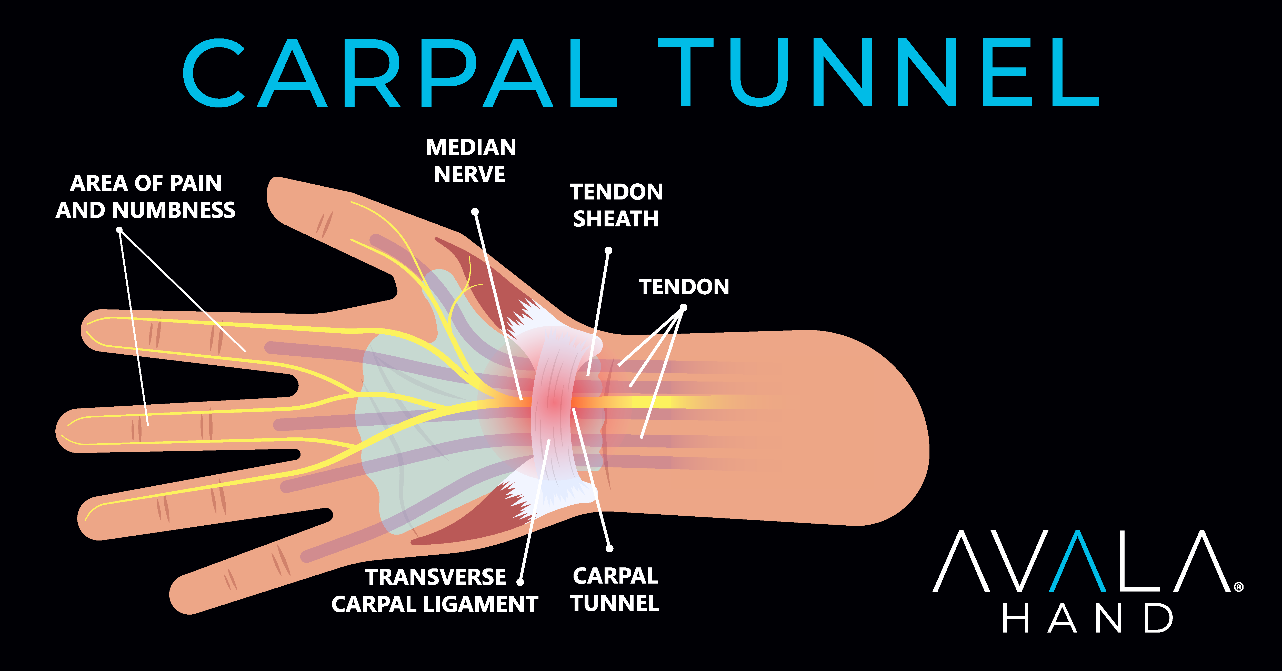 Carpal Tunnel Syndrome
