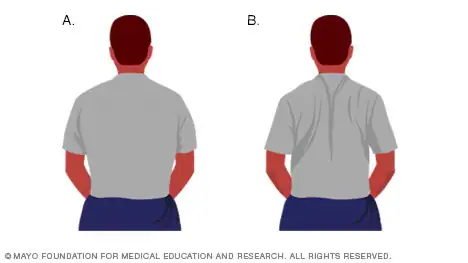 Best Physiotherapy for Cervical Spondylitis in Kolkata 4 lb00001 d shoulder blade squeeze